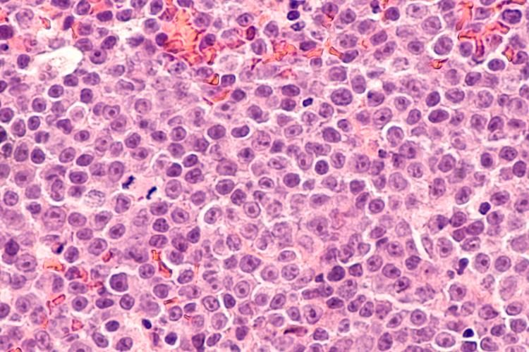 Photomicrograph of a diffuse large B-cell lymphoma