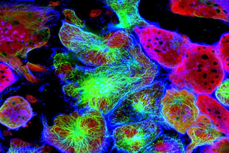 Tumour cells under microscope labelled with fluorescent molecules