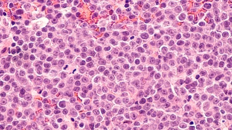 Photomicrograph of a diffuse large B-cell lymphoma