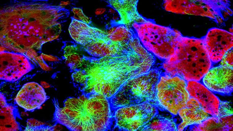 Tumour cells under microscope labelled with fluorescent molecules