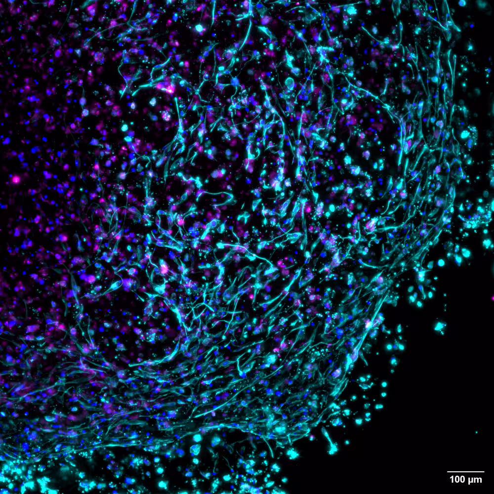 3D-bioprinted living tumour, derived from donor glioblastoma tissue. Captured under a Leica DMi8 microscope, blue hues highlight cell nuclei, while pink and turquoise reveal cancer-associated fibroblasts