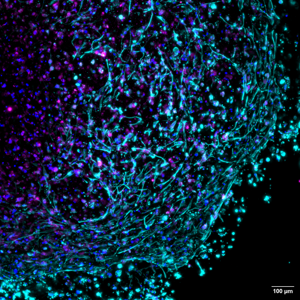 3D-bioprinted living tumour, derived from donor glioblastoma tissue. Captured under a Leica DMi8 microscope, blue hues highlight cell nuclei, while pink and turquoise reveal cancer-associated fibroblasts