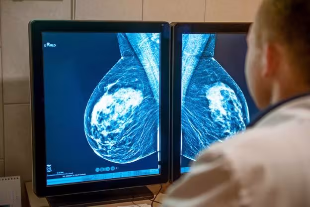 Over the shoulder shot of breast cancer imaging shown on a computer monitor