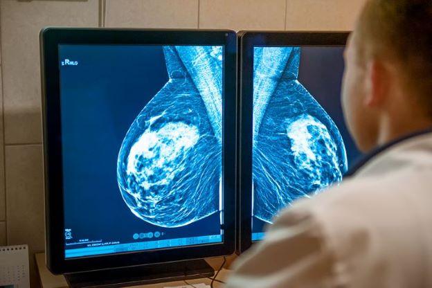 Over the shoulder shot of breast cancer imaging shown on a computer monitor